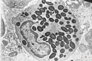 M,66y. | bone marrow - eosinophilic granulocyte M,66y. | bone marrow - eosinophilic granulocyte